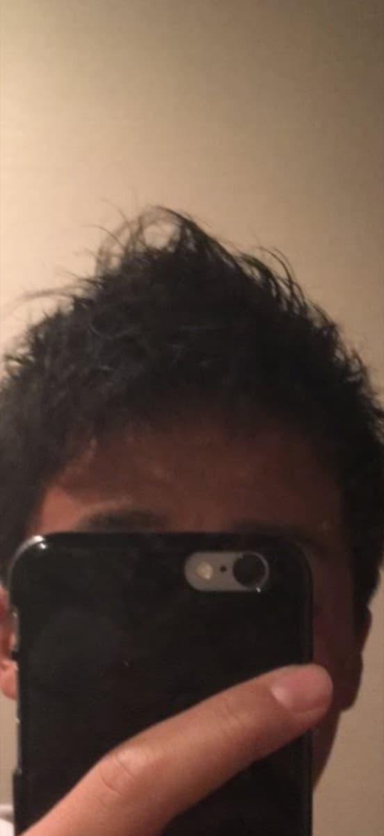 17歳当時 - AGA発覚時の生え際