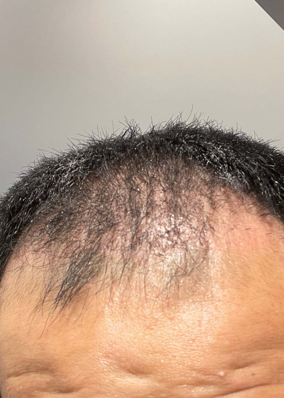 植毛ダウンタイム中の頭皮